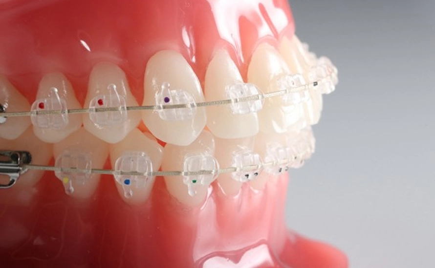 Ceramic Braces (2)
