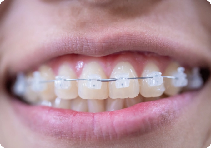 What Are Ceramic Braces